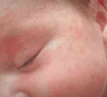 Šta se podrazumijeva pod akni dojenčad i šta da radim?