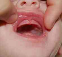 Uzroci gljivične infekcije u novorođenčadi u usta i kako se nositi sa bolešću