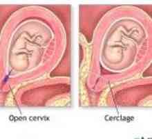 Cervikalni nesposobnosti. Siptomy i liječenje CIN u trudnoći