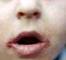 Kako tretirati perleches na usnama djeteta