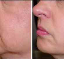 Anti-aging tretmani za lice