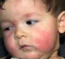 Tretman alergije na hranu kod djece
