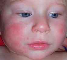 Tretman različitih oblika dermatitisa kod novorođenčadi