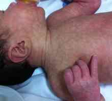 Marble kože kod beba: patologija ili norma?
