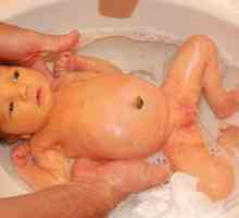 Marbling kože kod novorođenčadi