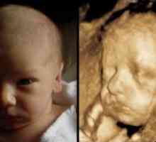 Fetusa nosne kosti: normalno