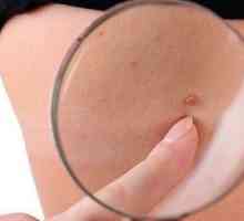 Papiloma tokom trudnoće