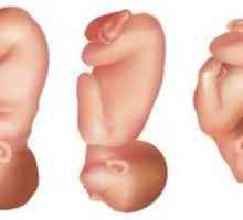 Perednegolovnoe, lica i frontalni prezentacija fetusa