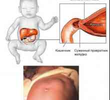 Stenoza pilorusa u dojenčadi