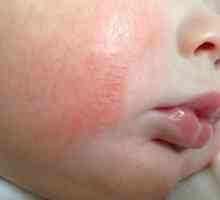 Zašto u novorođenčadi pojavljuje pahuljast kože