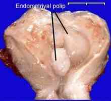 Vrata maternice i endometrija polip