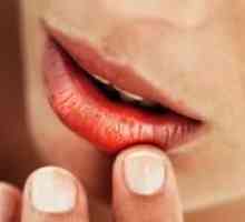 Uzroci i tretman pukotina u uglovima usta