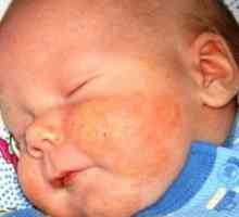 Uzroci, simptomi i liječenje alergija kod djece