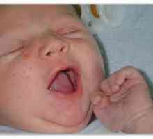 Uzroci osipa kod novorođenčadi i strategije liječenja