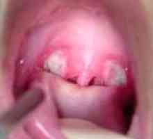 Simptomi akutne i hronične faringitis