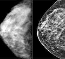 Simptomi raka dojke i metode za ranu dijagnozu bolesti