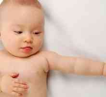 Suha koža u novorođenčadi i novorođenčadi