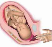 Opreme i druge karakteristike amniotomije