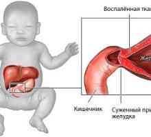Kongenitalna hipertrofična stenoza pilorusa u dojenčadi