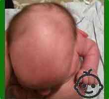 Kosa pada u dojenčadi