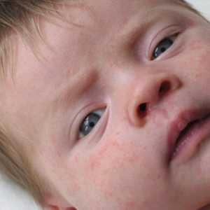 Koji su infantilno akne i šta da radim s njima?