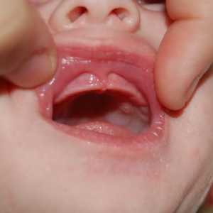 Uzroci gljivične infekcije u novorođenčadi u usta i kako se nositi sa bolešću