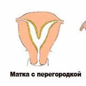 Dva roga uterusa i trudnoća