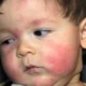 Tretman alergije na hranu kod djece