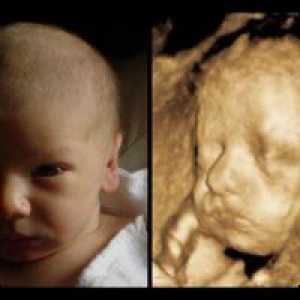 Fetusa nosne kosti: normalno