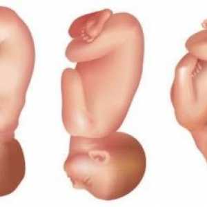 Perednegolovnoe, lica i frontalni prezentacija fetusa