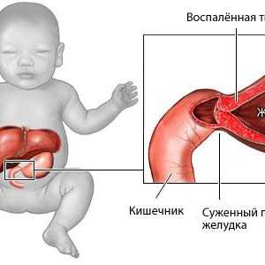 Kongenitalna hipertrofična stenoza pilorusa u dojenčadi